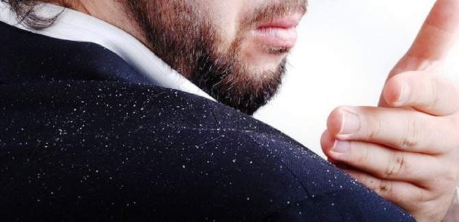 natural remedies for dandruff problem