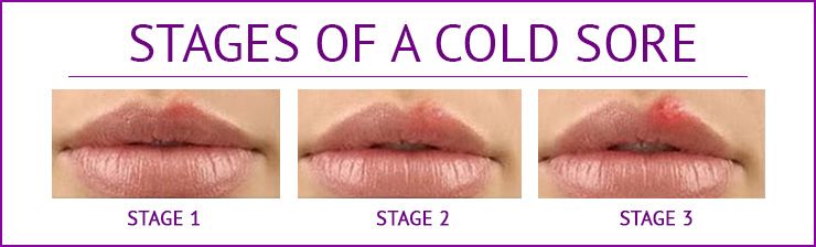 cold sore stages days