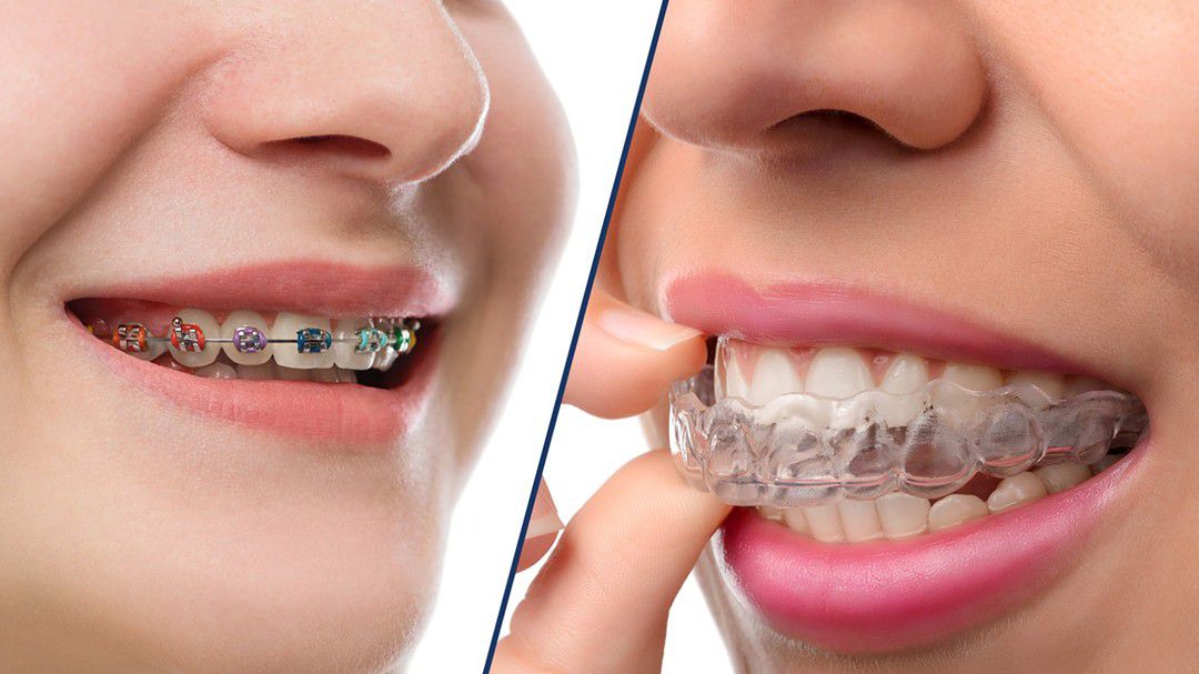 alternatives to braces