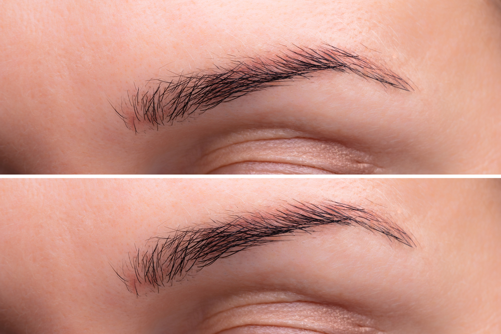 Brow Lift Treatment