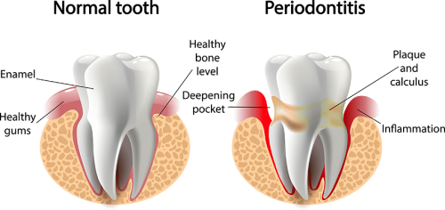 reverse periodontal disease